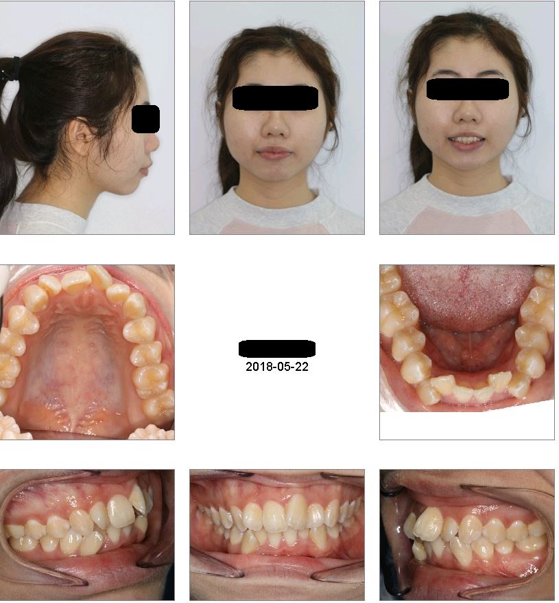 22 Class II division 1 malocclusion