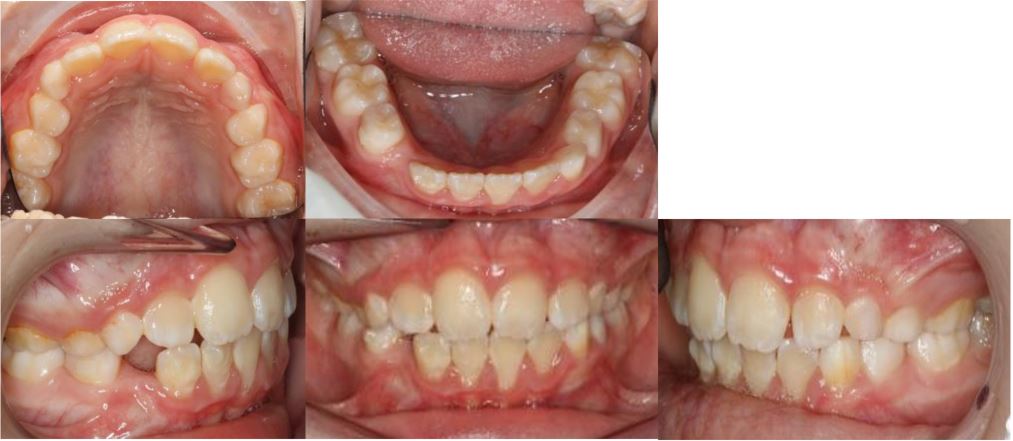 POST TREATMENT INTRAORAL Impacted LR3 mixed dentition