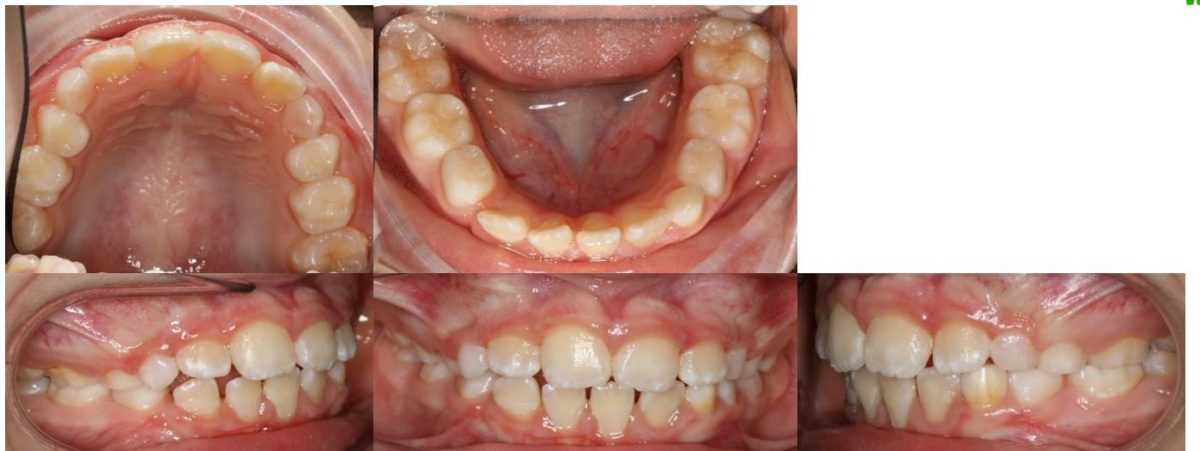 pretx intraoral montage impacted LR3 mixed dentition montage