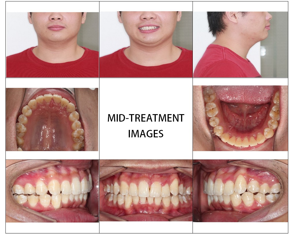 Clear Correct Aligners Patient Before and Afters - McOmie Family